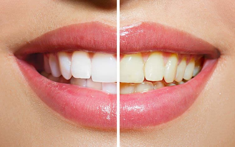 A satisfied patient with a radiant, white smile, symbolizing the confidence boost from effective teeth whitening Poole
