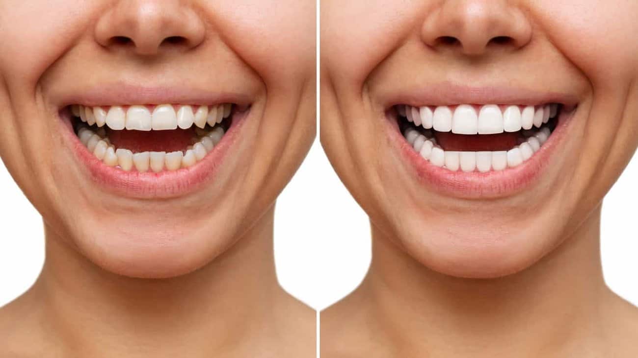 Contact Aspire White for teeth whitening services – Get in touch with Poole today