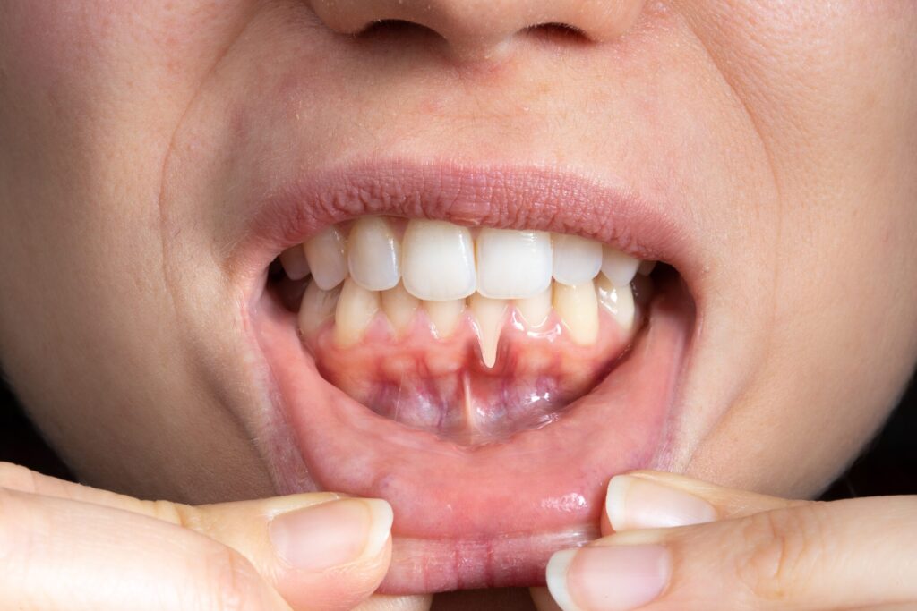 Preparing for teeth whitening with receding gums Poole