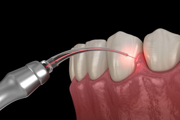 Receding Gums