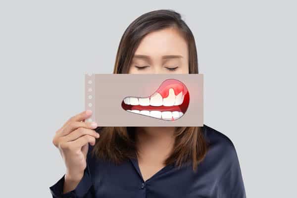 Receding Gums