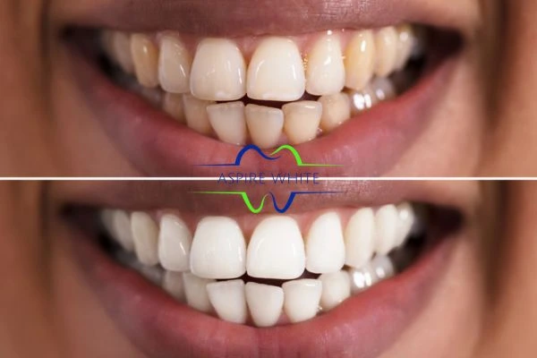 Aspire White customer before and after Poole results.