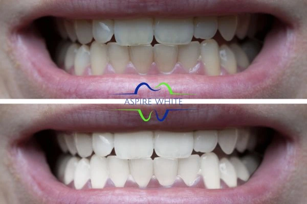 1 hour laser teeth whitening before and after results Poole