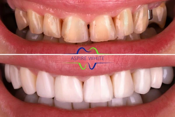 Yellow teeth results - 1 hour whitening before and after results Poole