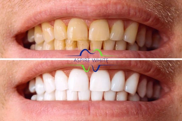 Get noticeable whiter smile in just one hour! Book your teeth whitening treatment Poole today!