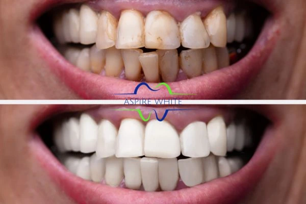 Before and after results of laser teeth whitening Poole Book in online today!