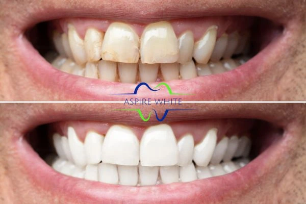 Before and after whitening results Poole